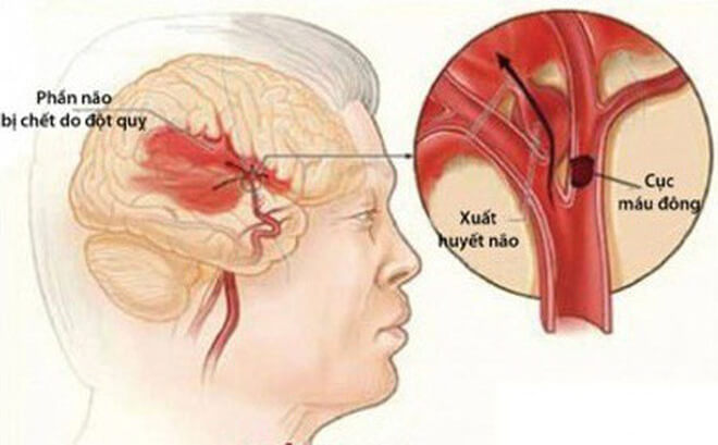 bệnh tai biến mạch máu não